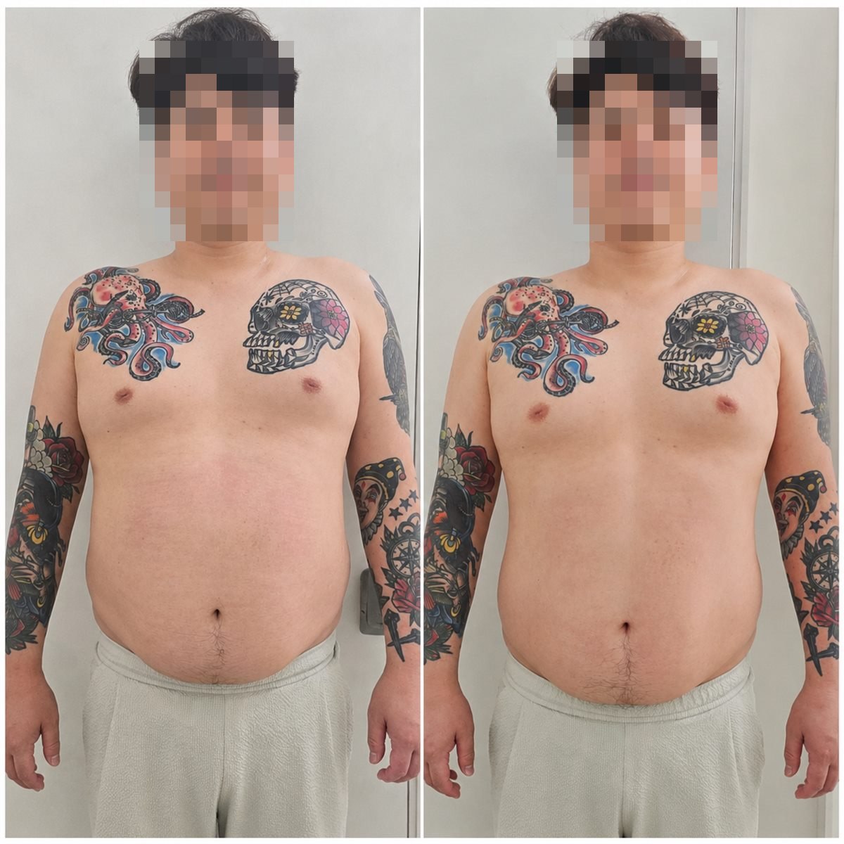 상체 정면 체형 관리 전후 비교 사진